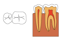 C1〜C2の虫歯
