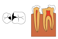 C3〜C4の虫歯