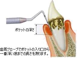 歯周プローブの使い方